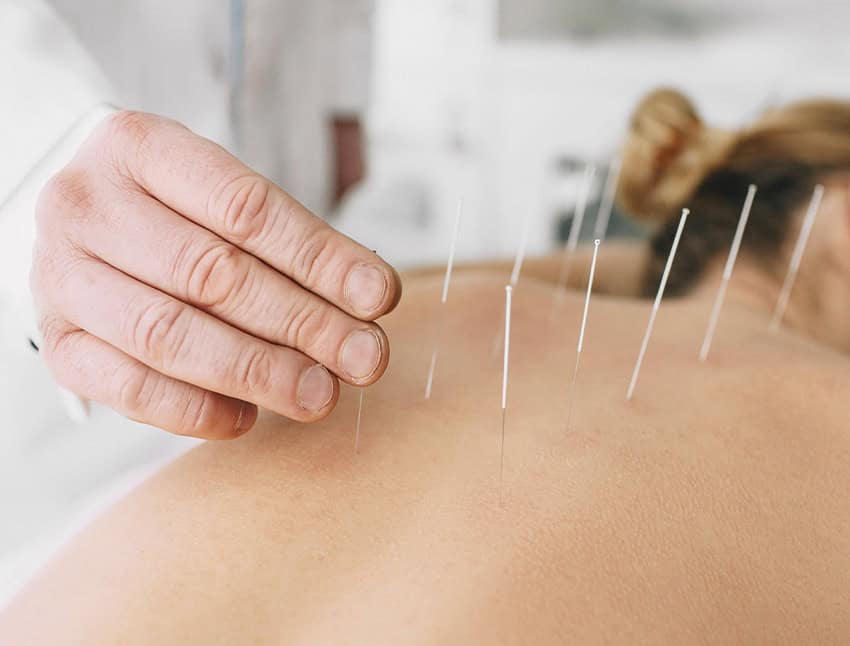 ACUPUNCTURE