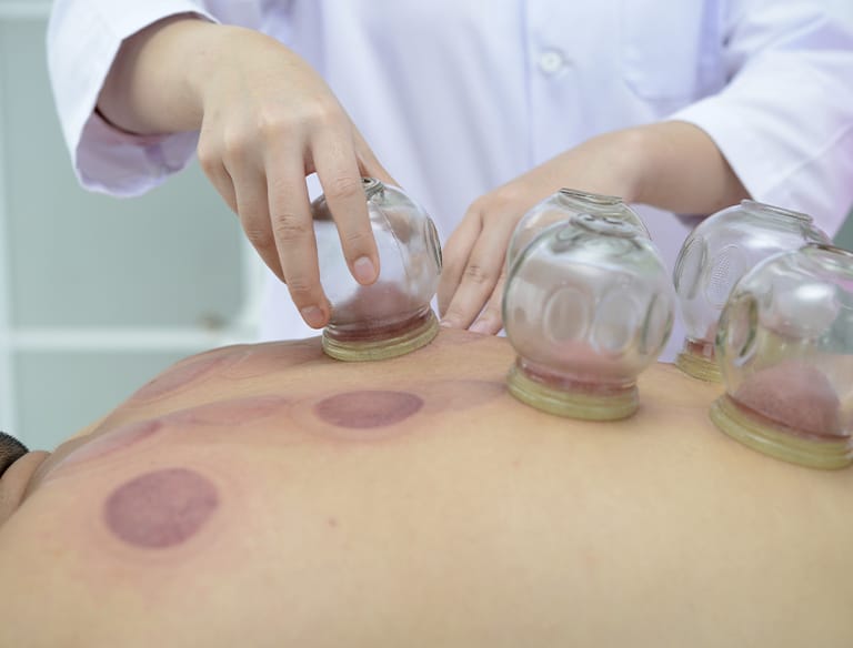 CUPPING