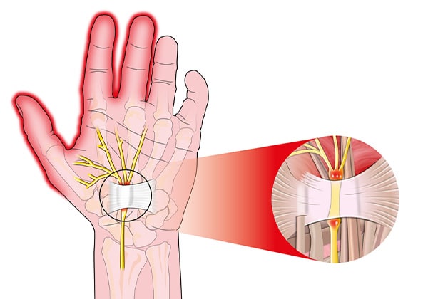 Causes Carpal Tunnel Syndrome